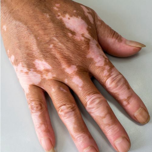 vitiligo
